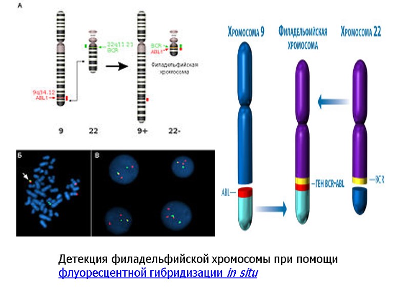 Детекция филадельфийской хромосомы при помощи флуоресцентной гибридизации in situ